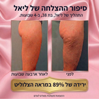 ערכה ביתית להפחתת הצלוליטיס 